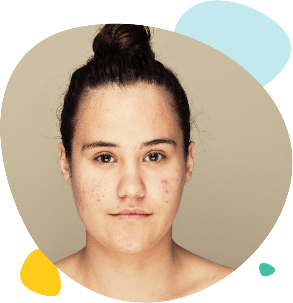Portrait d'une jeune fille atteinte d'acné sévère