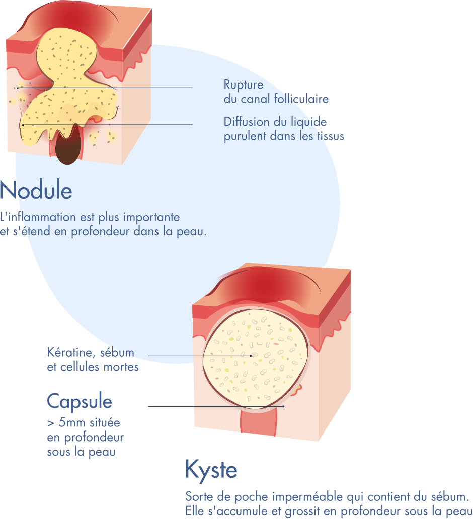 Schema d'un nodule et d'un kyste - Infographie Acne severe