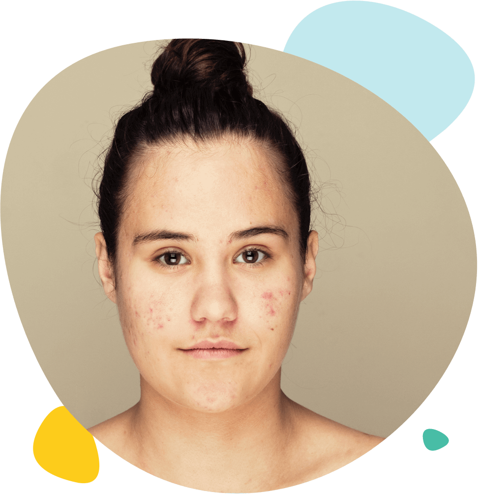 Portrait d'une jeune fille atteinte d'acné sévère