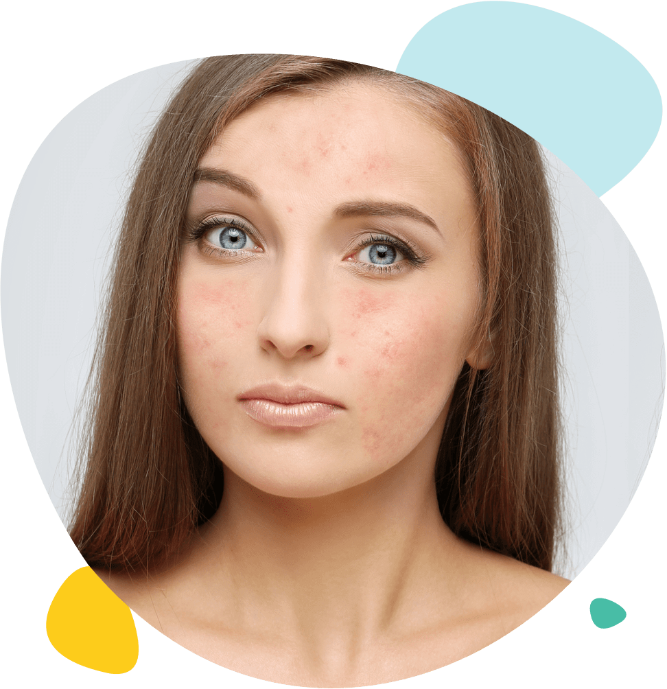 Portrait d'une jeune fille avec des cicatrices