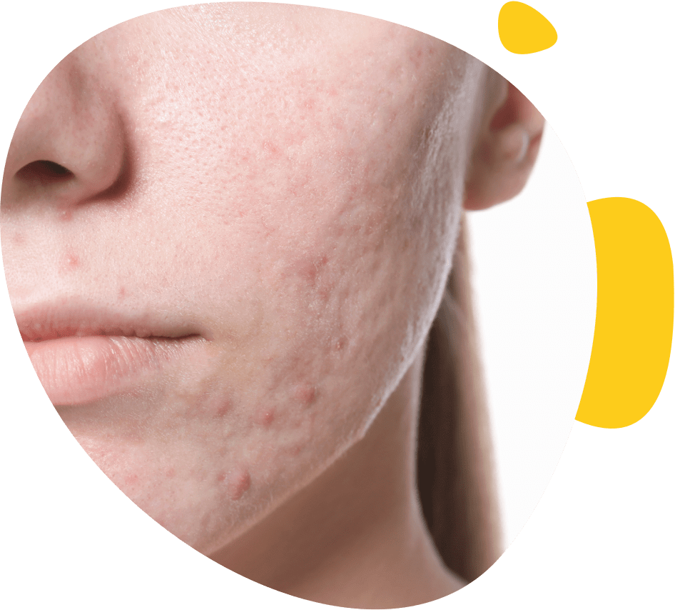 Portrait d'une jeune fille avec des cicatrices