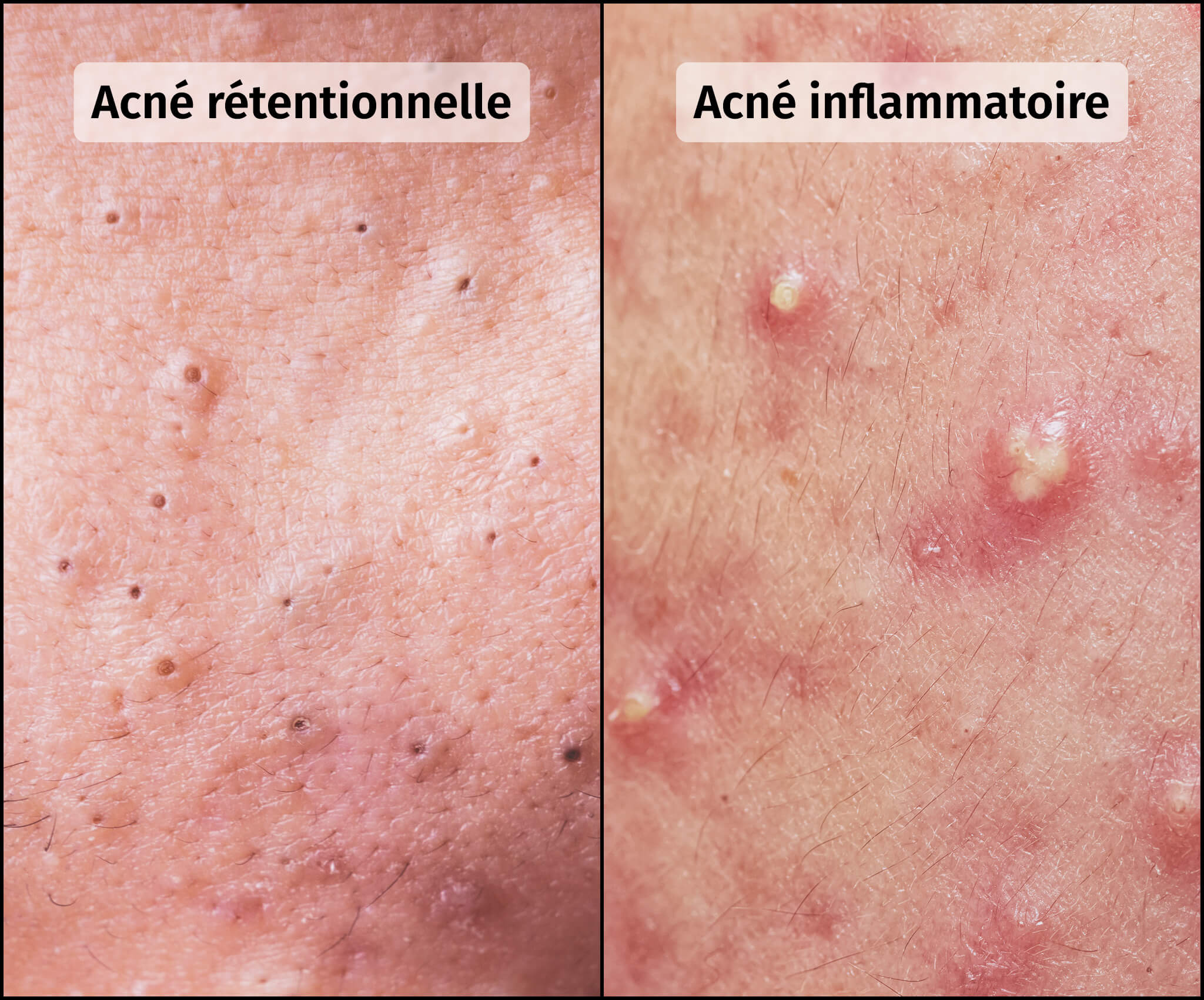 Schéma d'un bouton d'acné - Infographie Acne severe