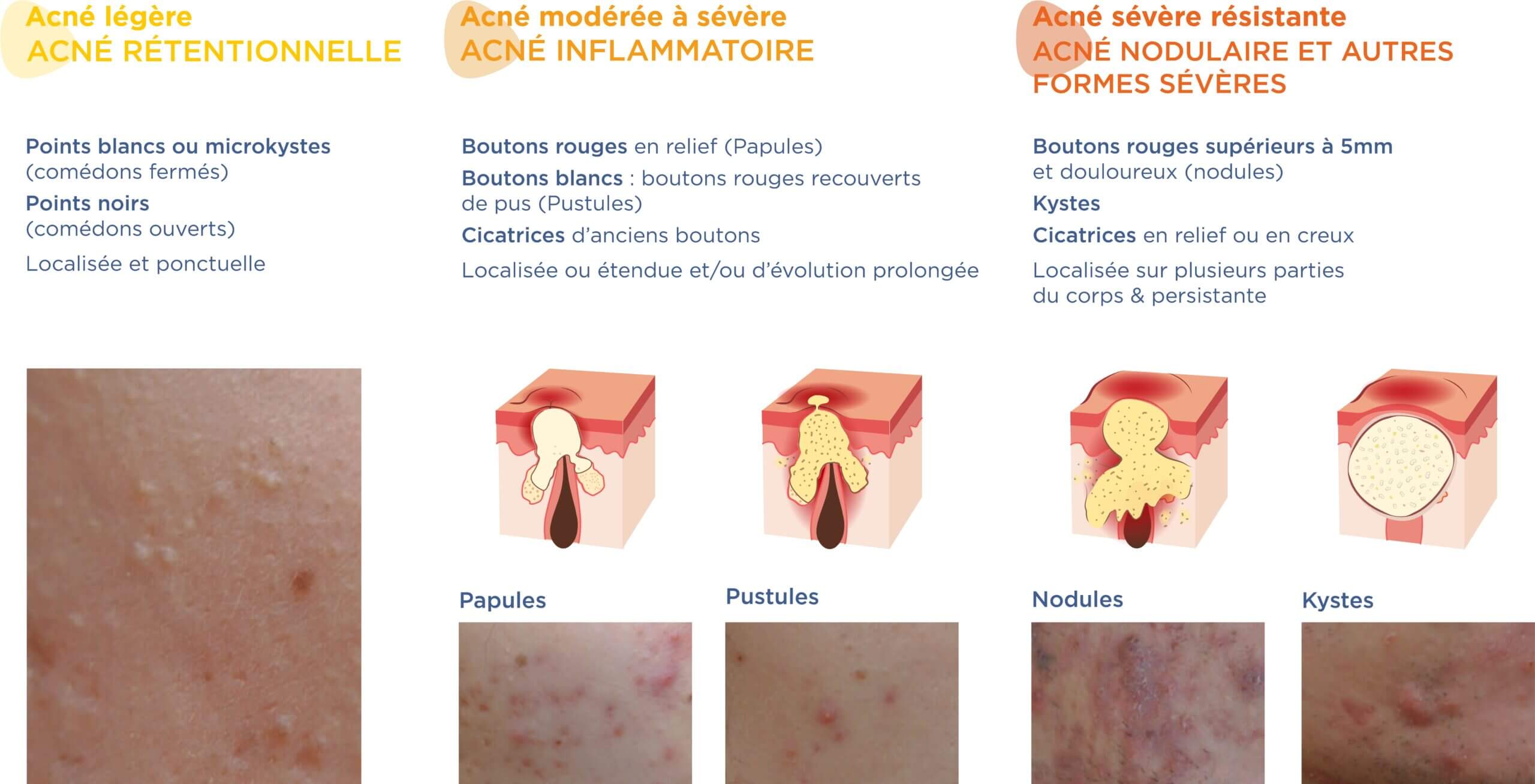 Acn Mod r e Du Dos ACNE VISAGE TRAITEMENT ACNE VISAGE